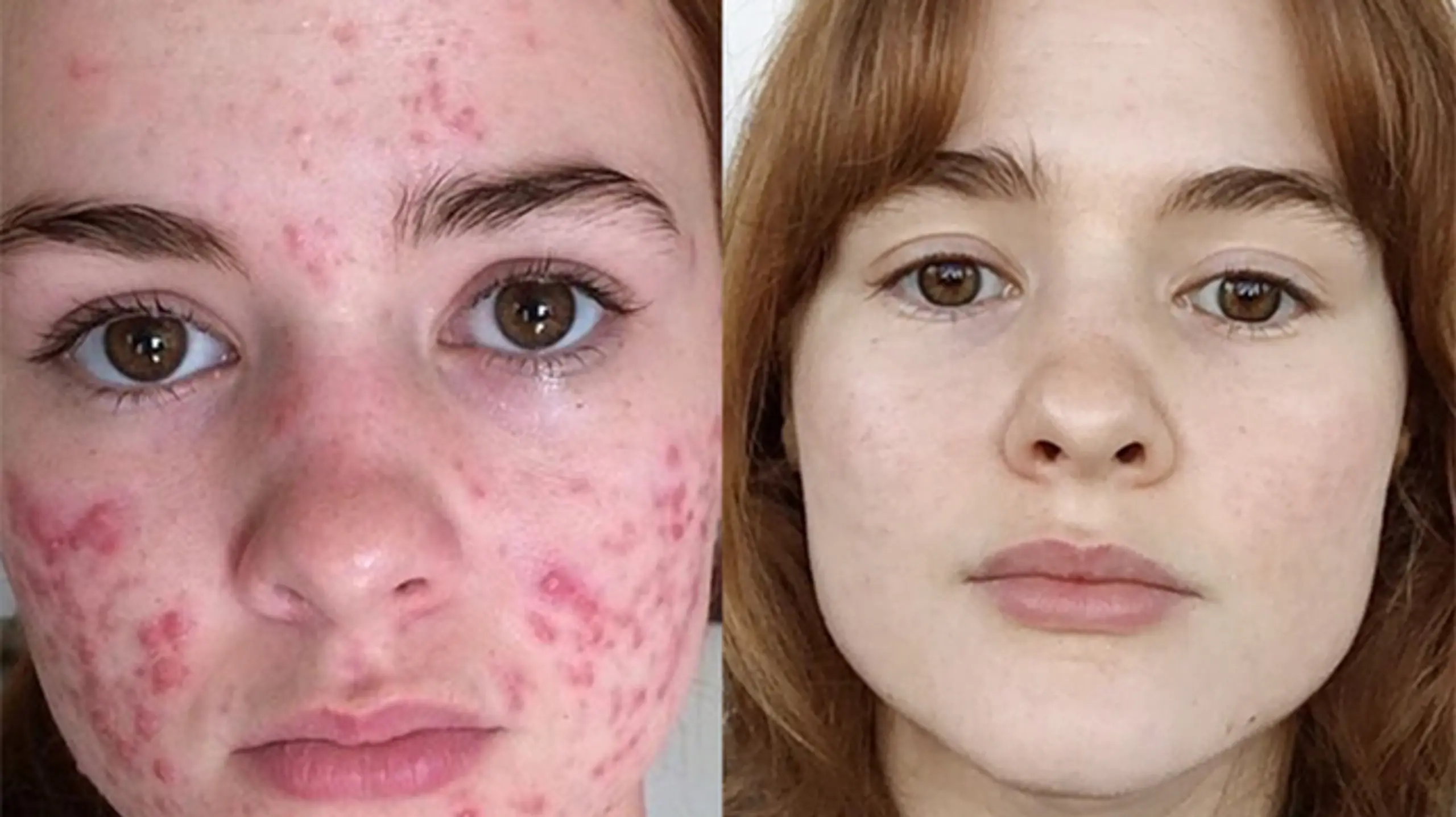 Kali Kuschner Akne Vorher Nachher