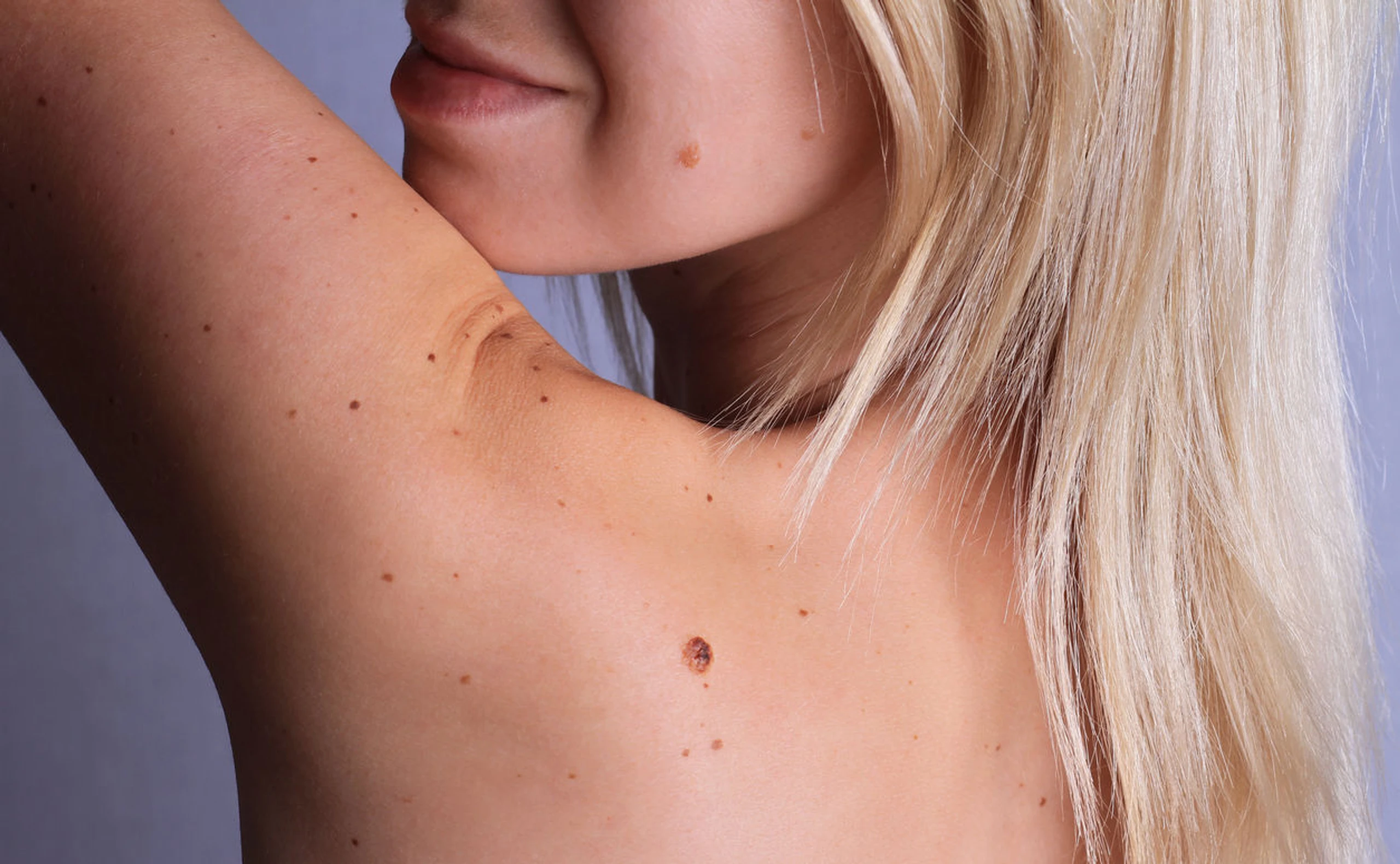 Hautkrebs selber erkennen