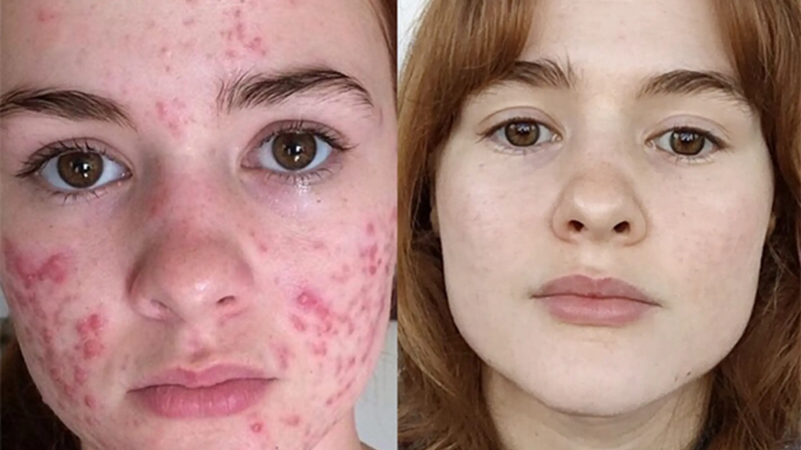 Kali Kuschner Akne Vorher Nachher