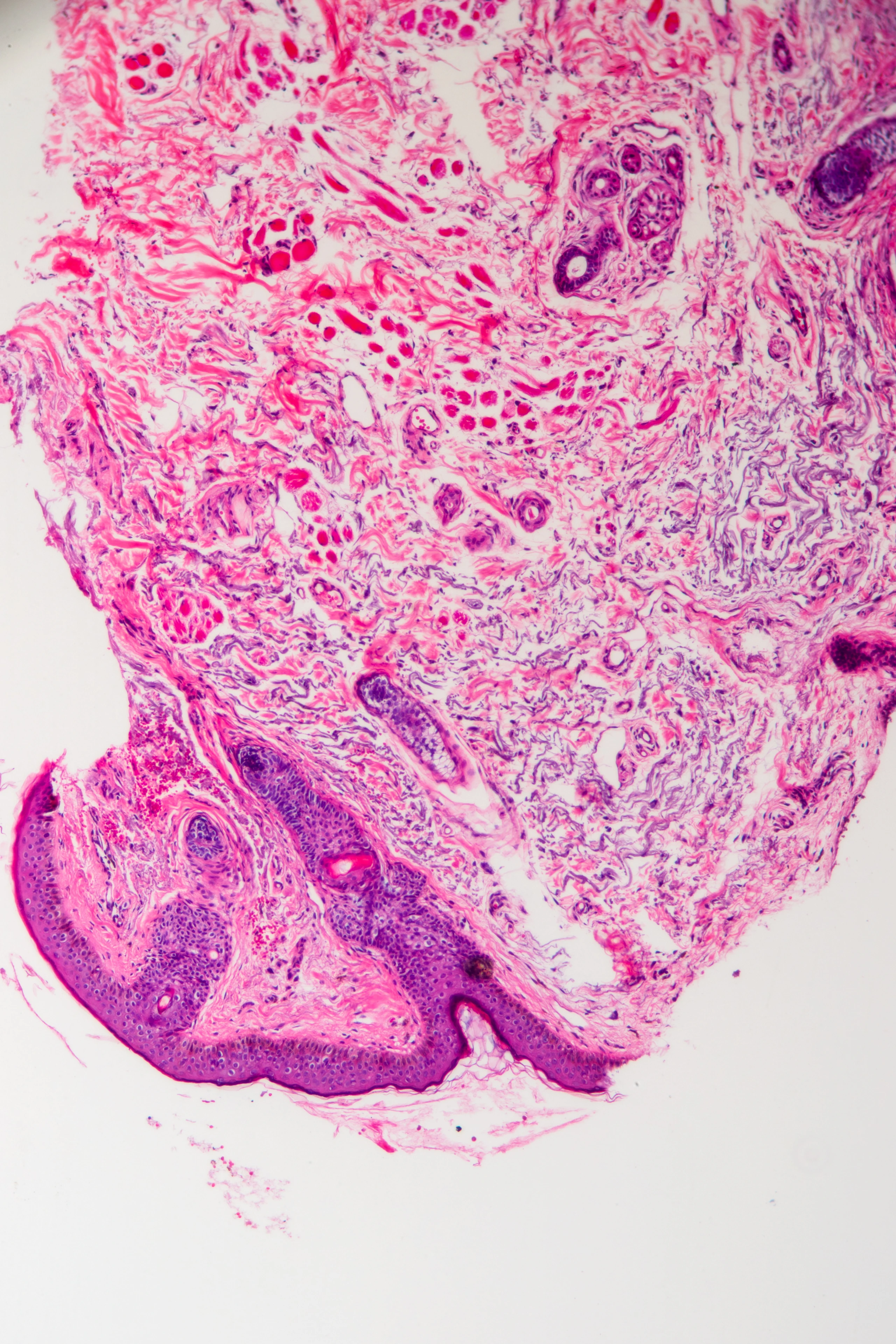 Blick in ein Basalzellkarzinom