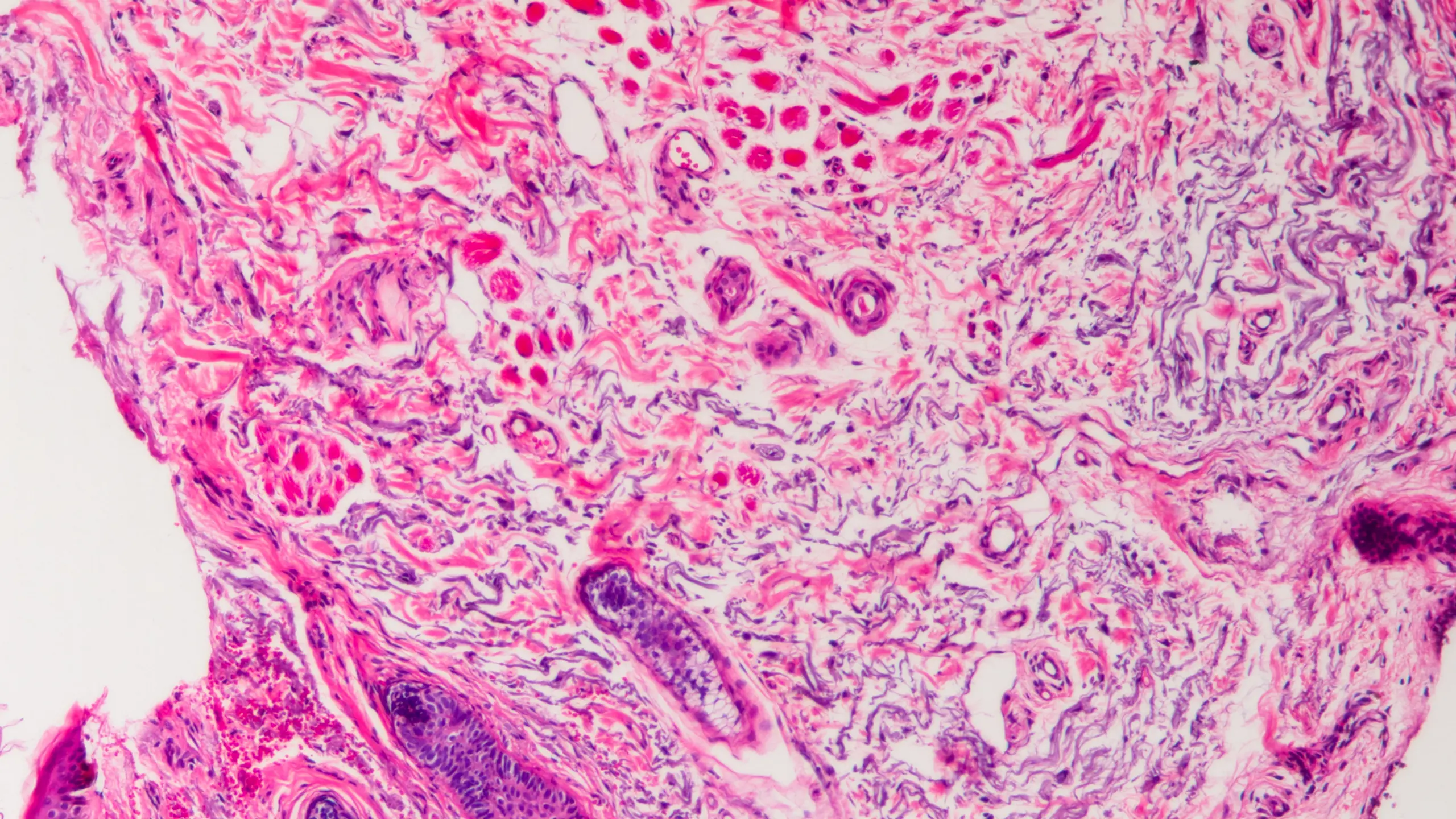 Blick in ein Basalzellkarzinom